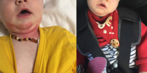 Baby Skin Rash Bacterial Infection Healed with Homeopathy-before-and-after