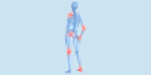 Osteoarthritis and Homeopathy: A Client Case